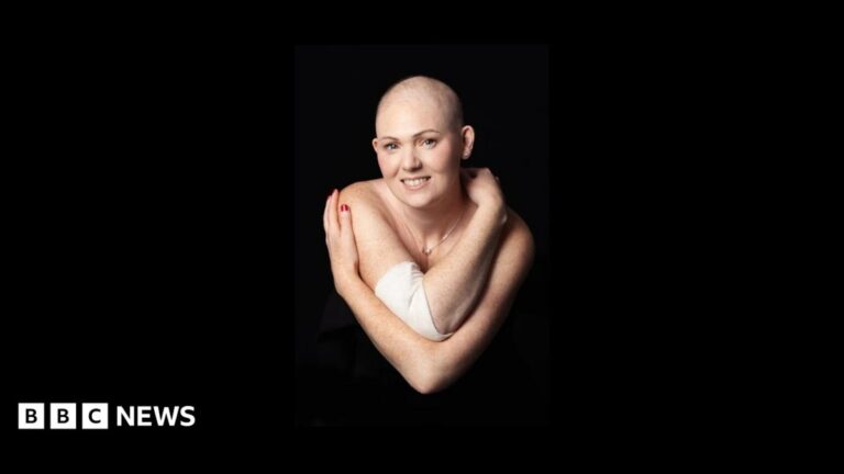 Chemo hair loss doesn't define me
