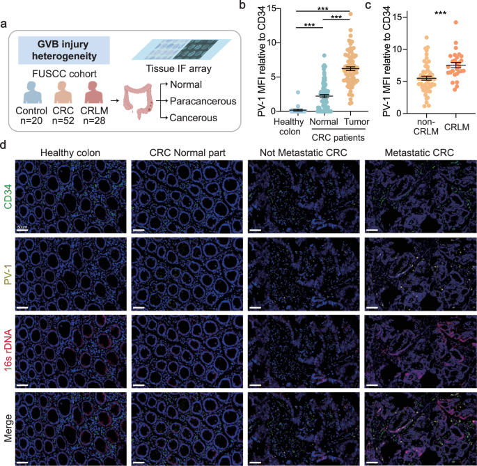 Eggerthella lenta disrupts the gut vascular barrier to drive colorectal cancer liver metastasis Eggerthella lenta disrupts the gut vascular barrier to drive colorectal cancer liver metastasis