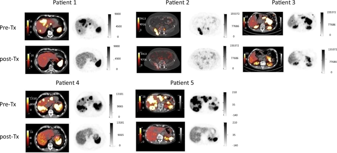 Immunogenic cell death as a mechanism of synergy between sunitinib and 177Lu-DOTATATE peptide receptor radionuclide therapy in pancreatic neuroendocrine tumors Immunogenic cell death as a mechanism of synergy between sunitinib and 177Lu-DOTATATE peptide receptor radionuclide therapy in pancreatic neuroendocrine tumors