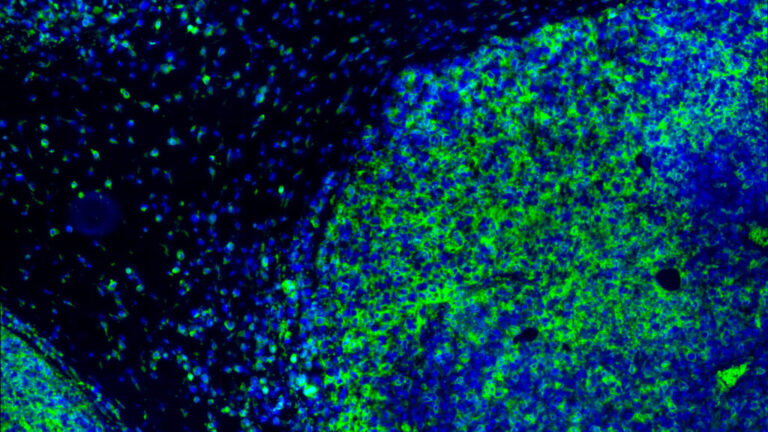 Immunotherapy sees striking response in some head and neck cancers Immunotherapy sees striking response in some head and neck cancers