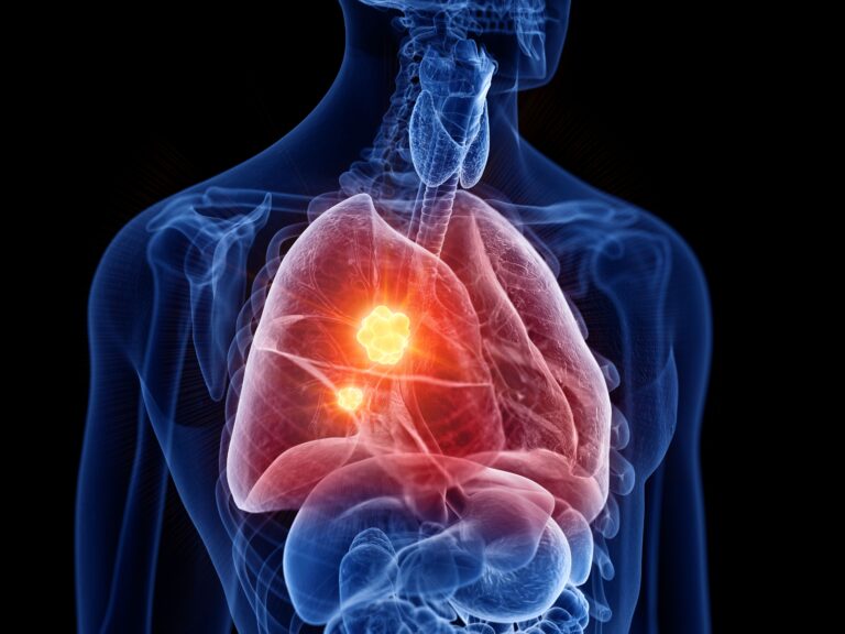 Nursing Strategies for the 3 First-Line Regimens in EGFR-Mutated NSCLC Time to worsening of symptoms was improved with amivantamab plus chemotherapy compared with chemotherapy alone in the phase 3 PAPILLON trial.