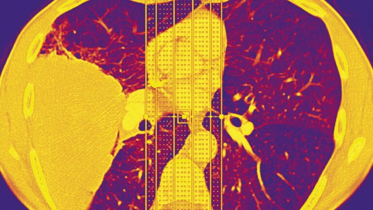 Rare gene variant raises lung cancer risk 25-fold in non-smokers Rare gene variant raises lung cancer risk 25-fold in non-smokers