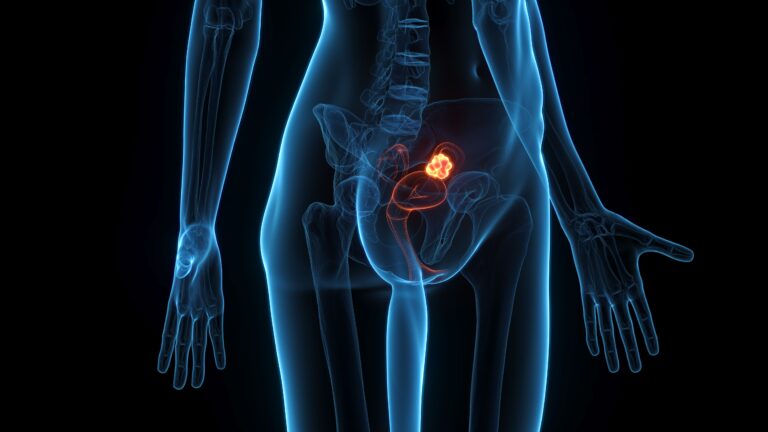 Relacorilant Combo Receives Positive CHMP Opinion in Ovarian Cancer NICE Recommends T-DXd for HER2-Low Metastatic Breast Cancer