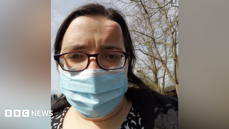 Rochester woman’s lump on head was ‘cancer eating hole in my skull’ A woman wearing glasses and blue face mask with a large lump on her forehead.