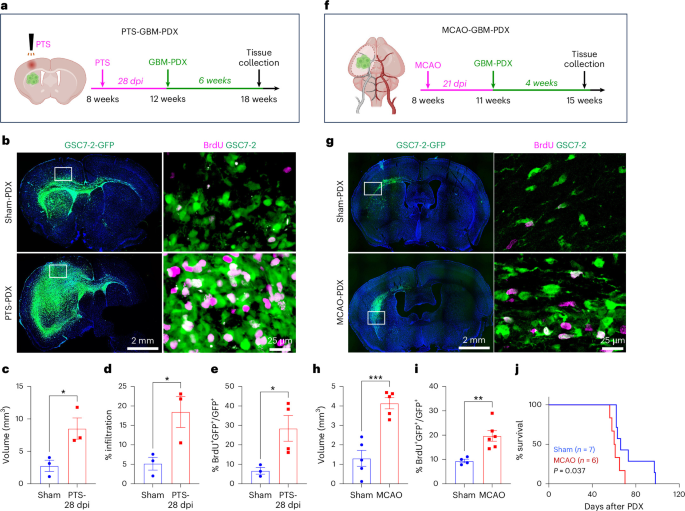 Stroke drives glioma progression through the emergence of tumor-associated astrocytes with reduced Ca2+ activity Stroke drives glioma progression through the emergence of tumor-associated astrocytes with reduced Ca2+ activity
