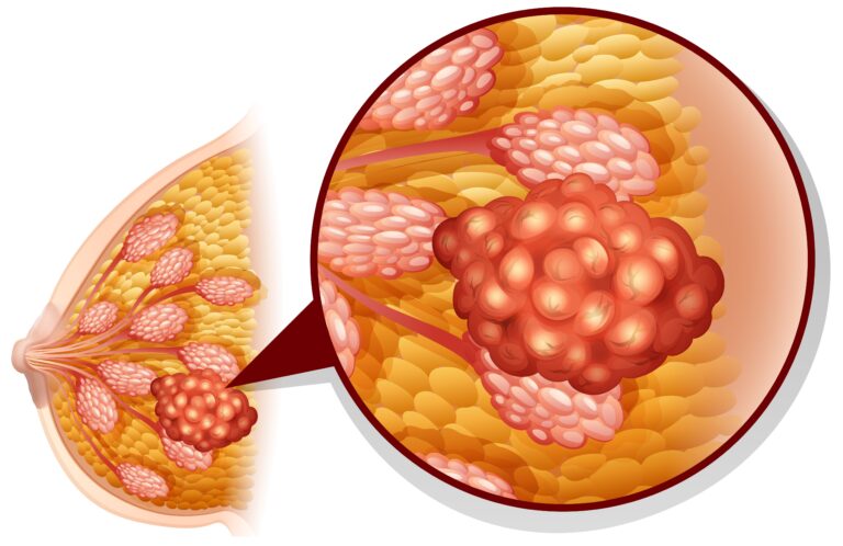 Hypofractionated PMRT Shows Durable 10-Year Control in High-Risk Breast Cancer